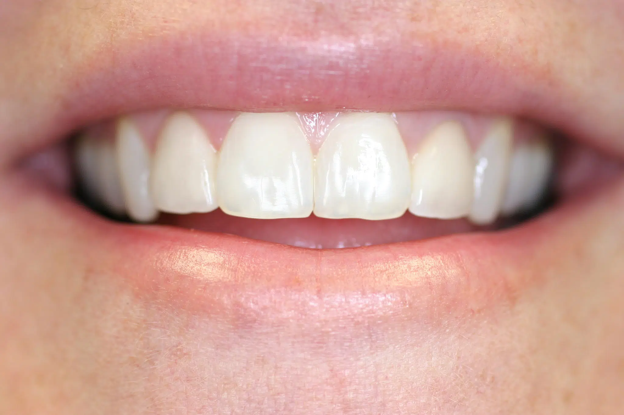 Before veneers