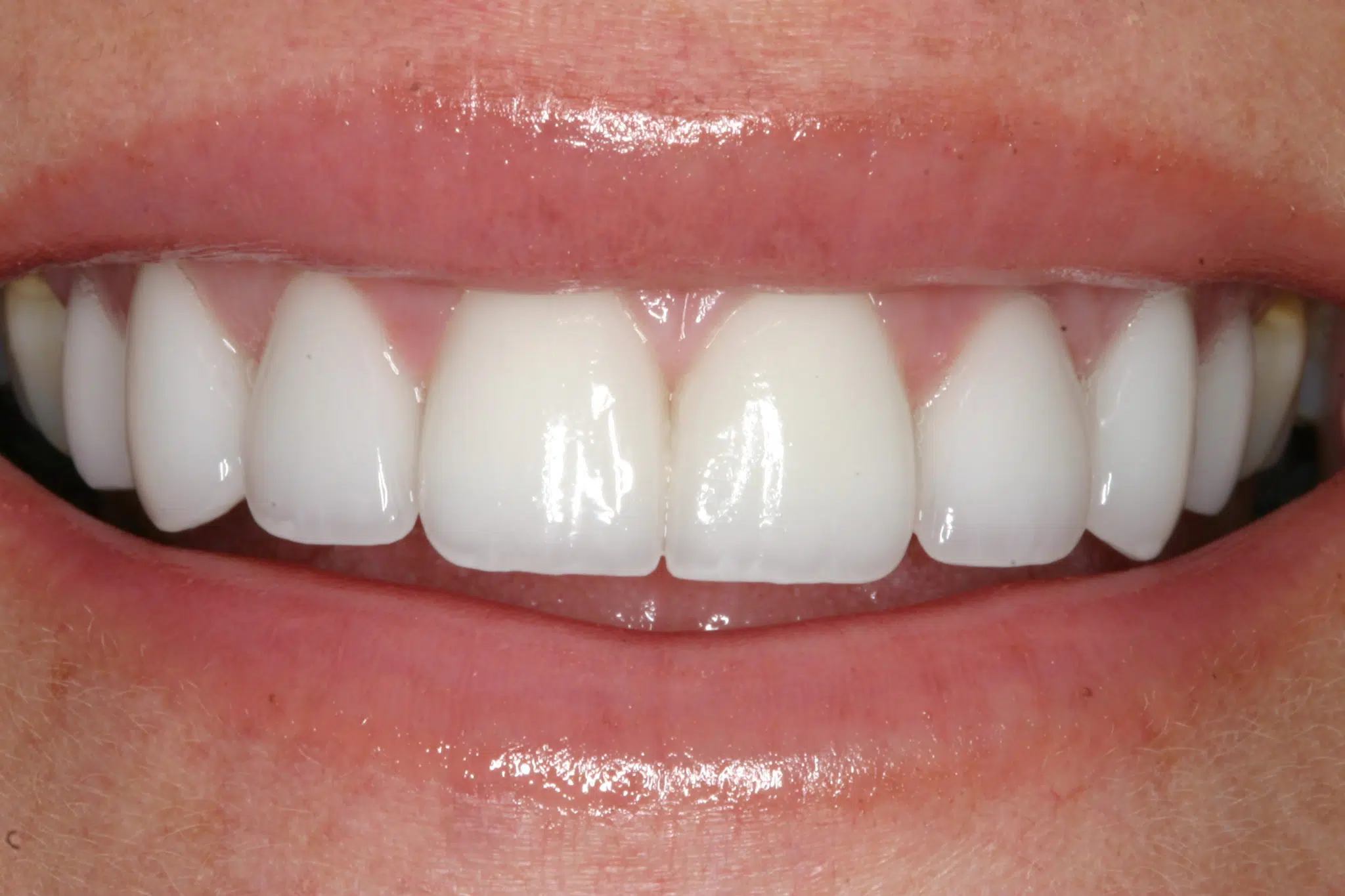 After veneers