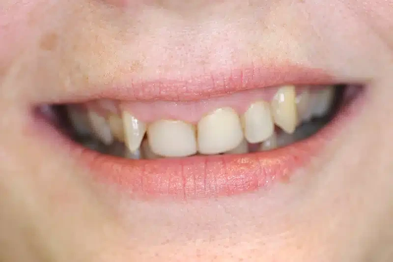 Before gum contouring