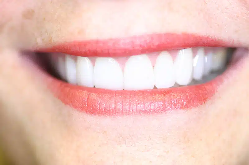 After gum contouring