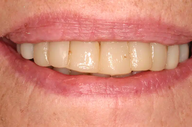 Before full mouth reconstruction