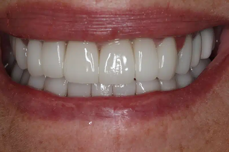 After full mouth reconstruction
