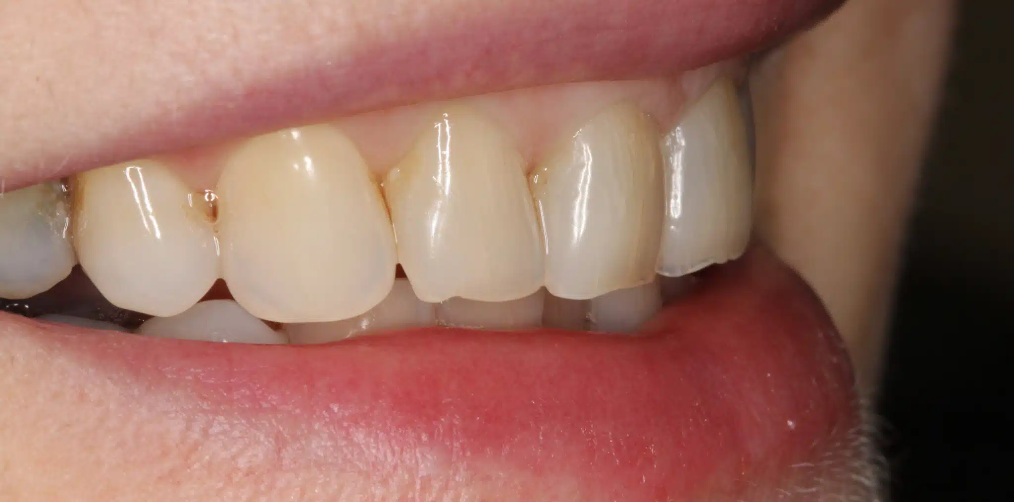 Before prepless veneers