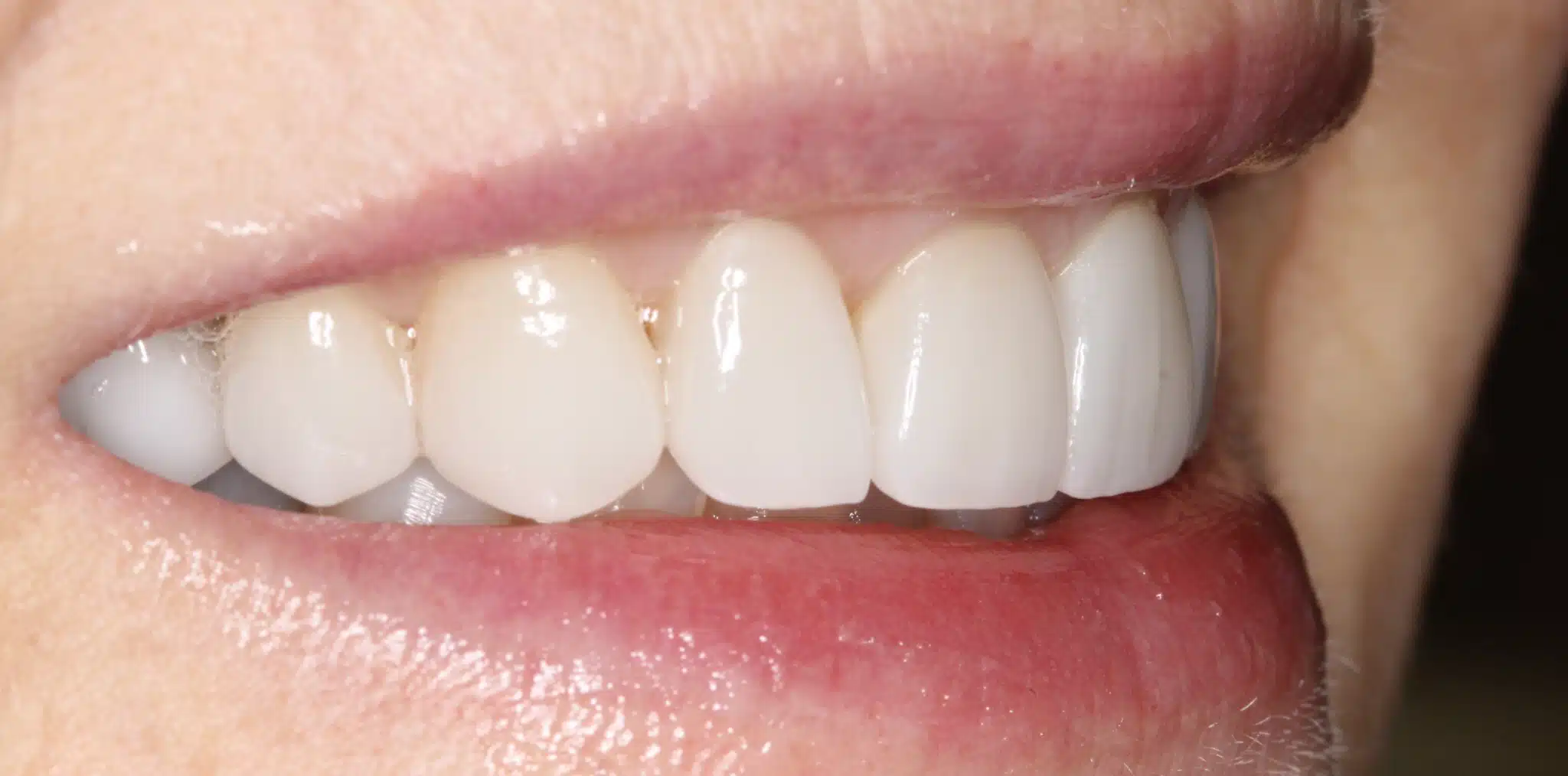 Before prepless veneers