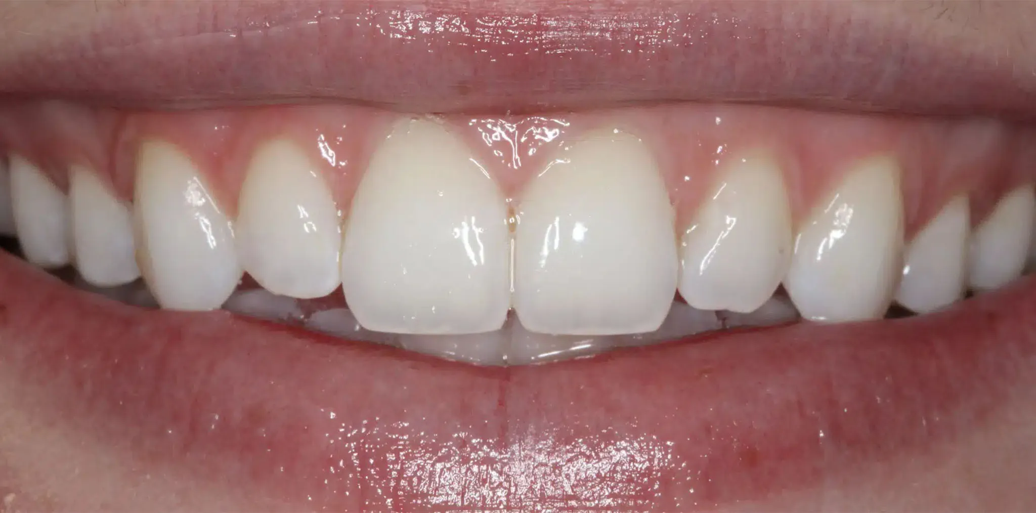Before prepless veneers
