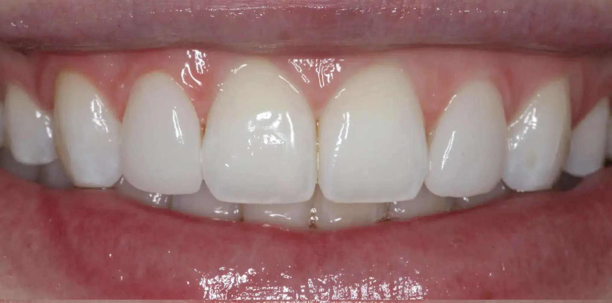 After prepless veneers