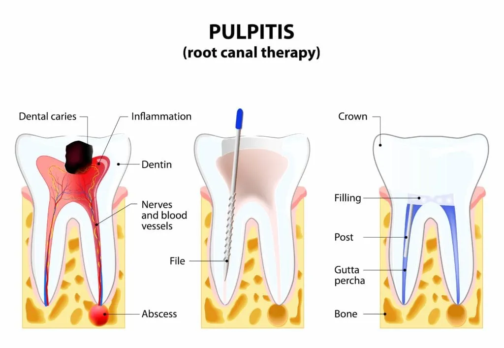 Diagram of root canal stages from infection to restoration with crown