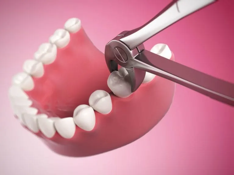 3D rendering of forceps extracting a tooth from the gum
