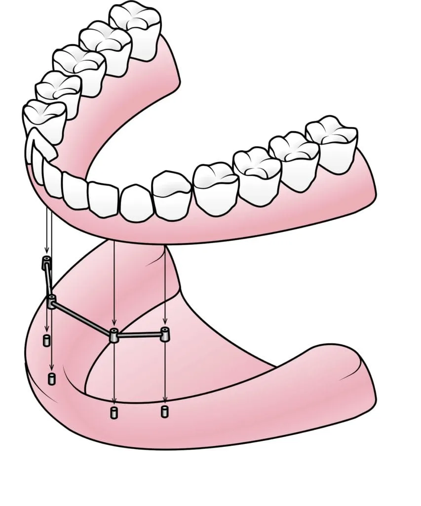 Bar-retained implant denture