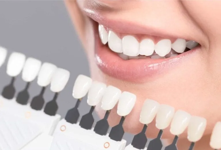 Smile with veneers