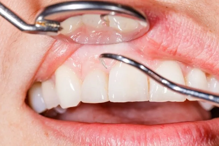 Close-up of a dental scaler cleaning along the gumline