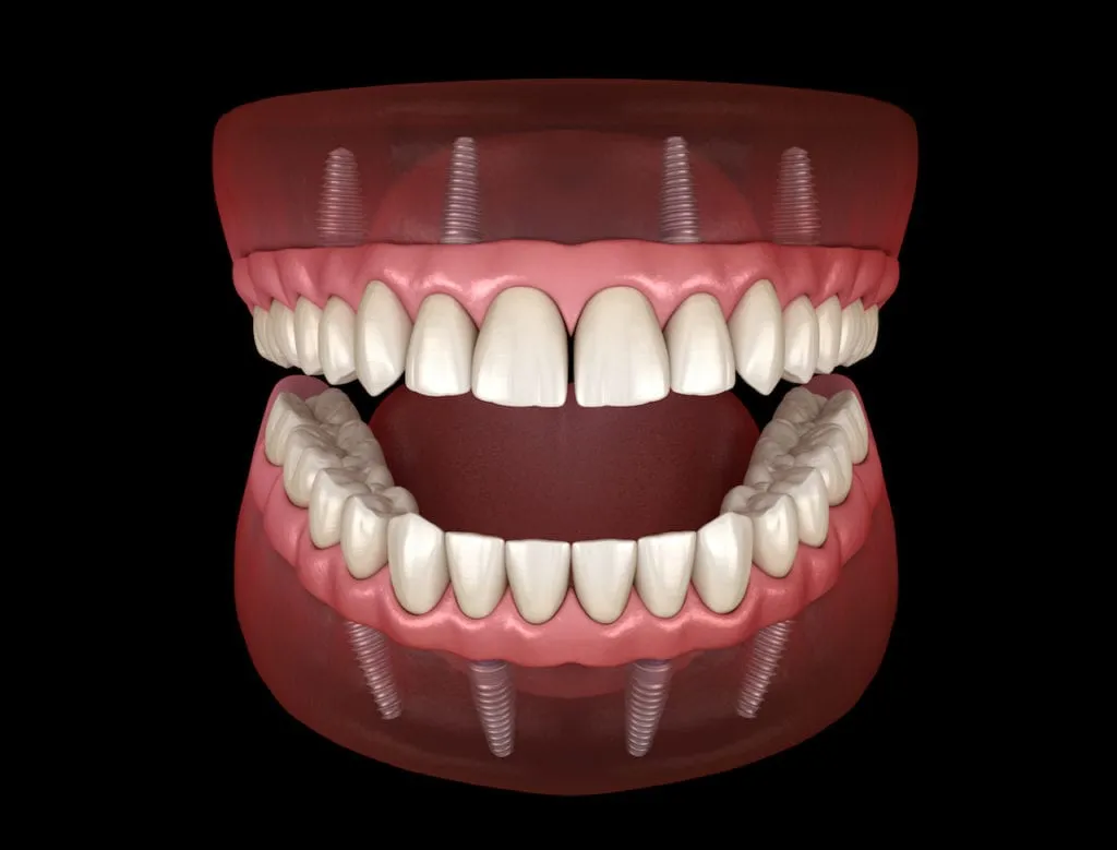3D rendering of an all-on-4 denture with four implant posts