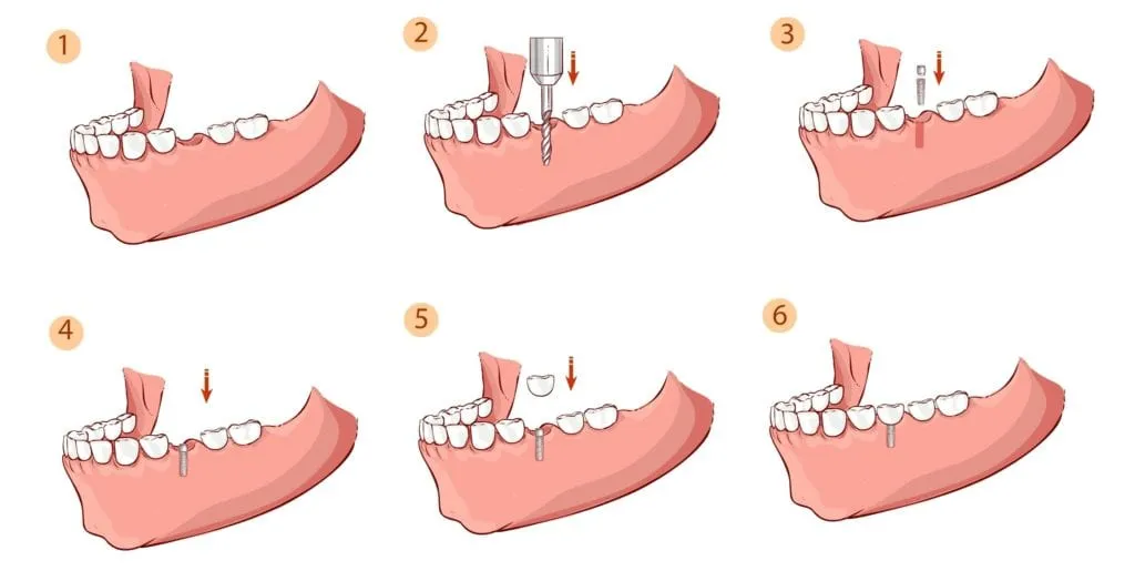 Six-step diagram of the dental implant placement process