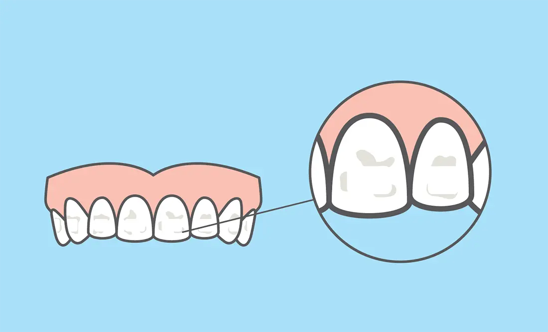 digital drawing of teeth with white spots