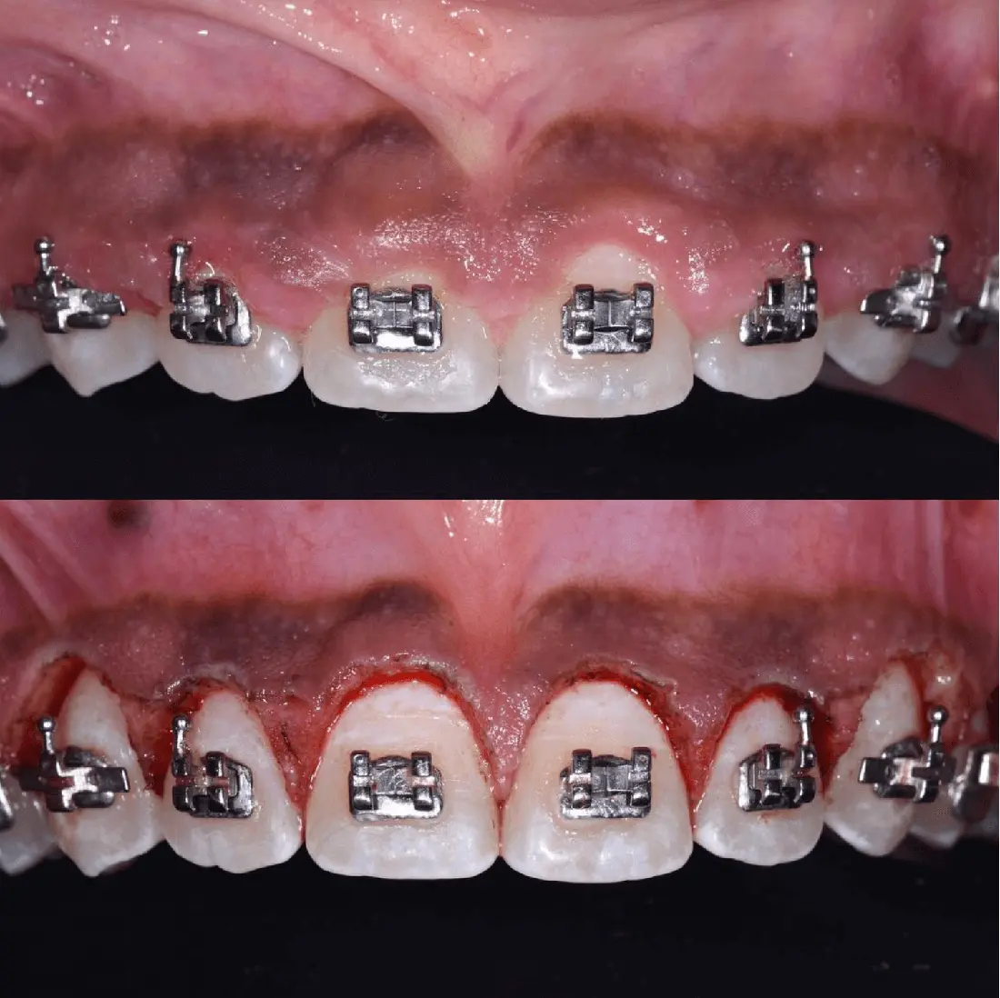 Close up photo of before and after laser gum surgery at Stable Orthodontics