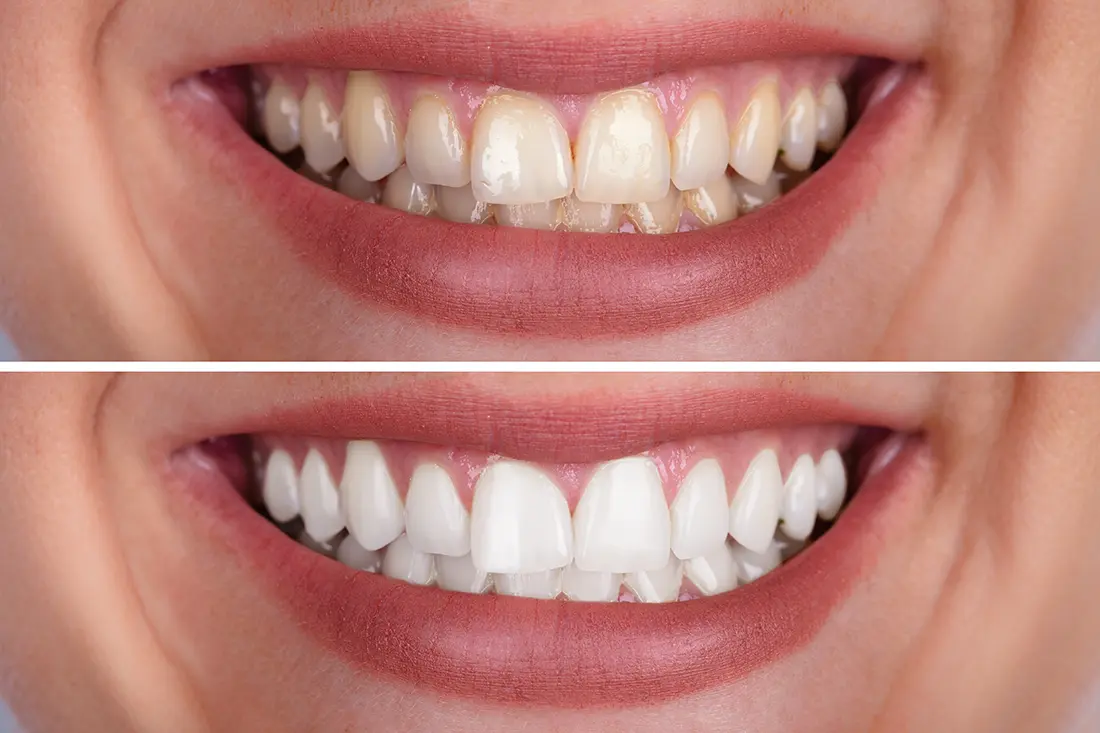 photo of before and after teeth whitening procedure