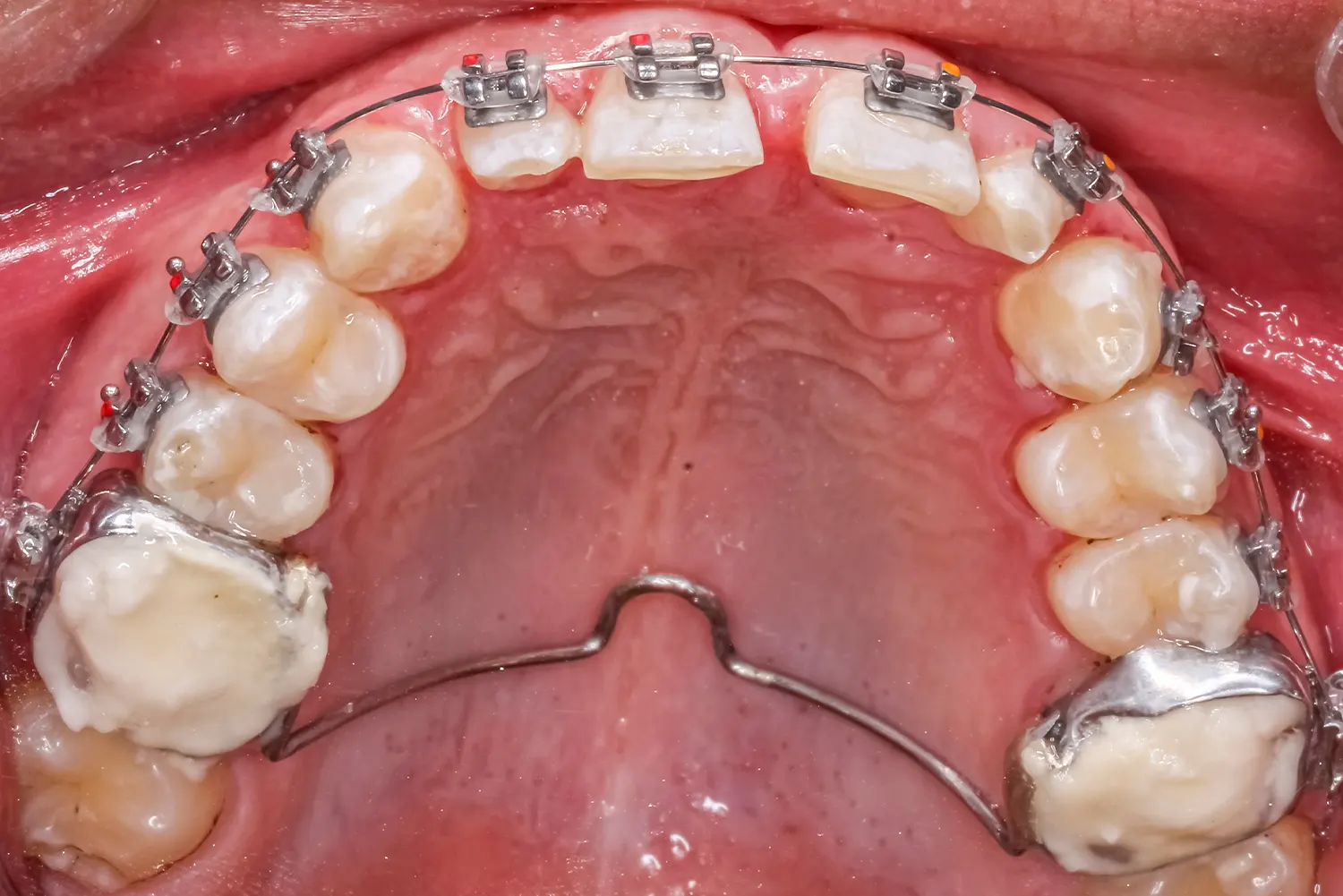 photo of mouth with upper expander