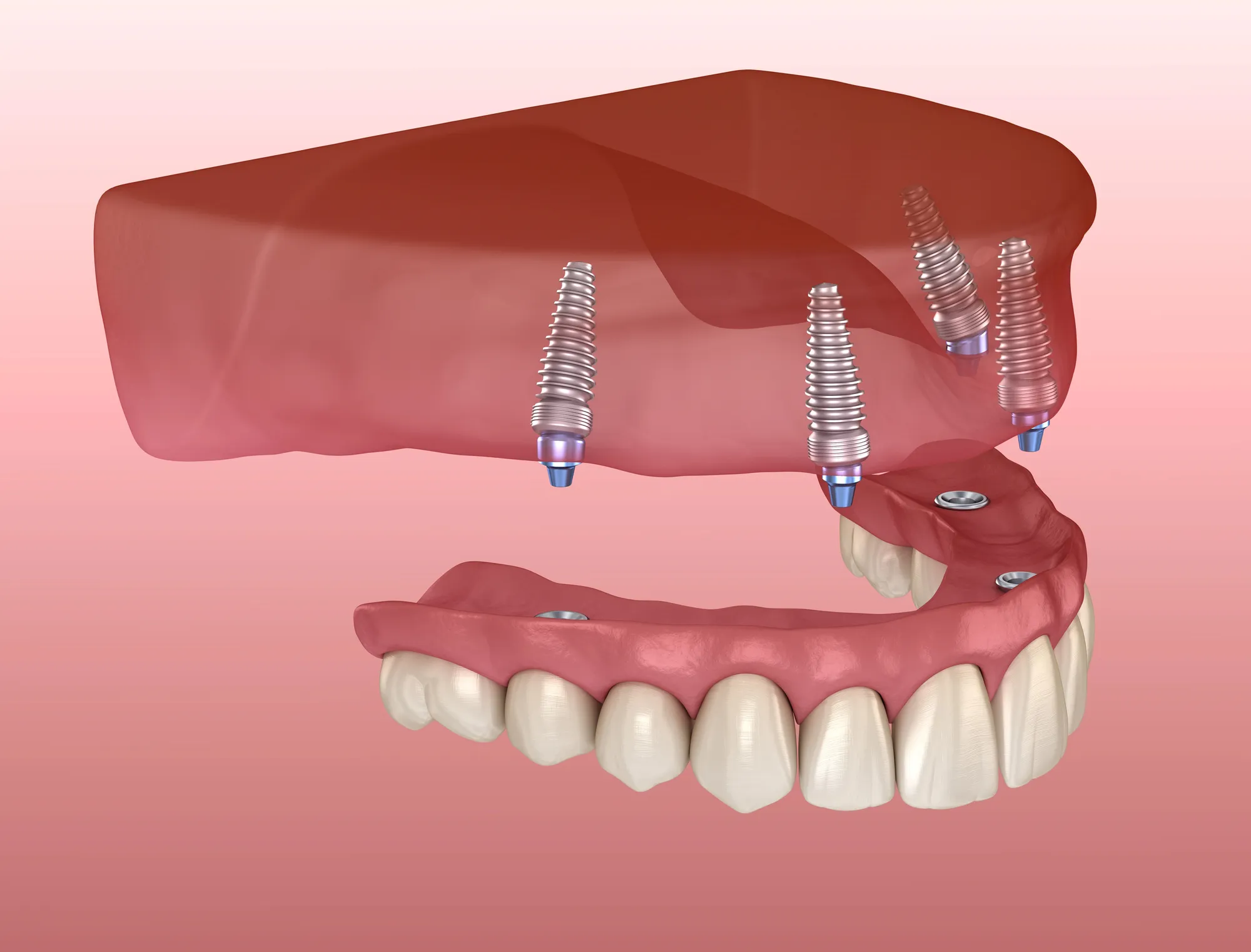 illustration of all-on-4 dental implants
