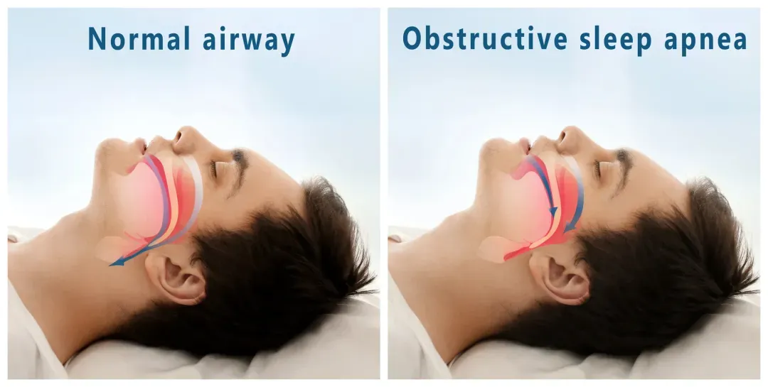 sleep apnea demostration